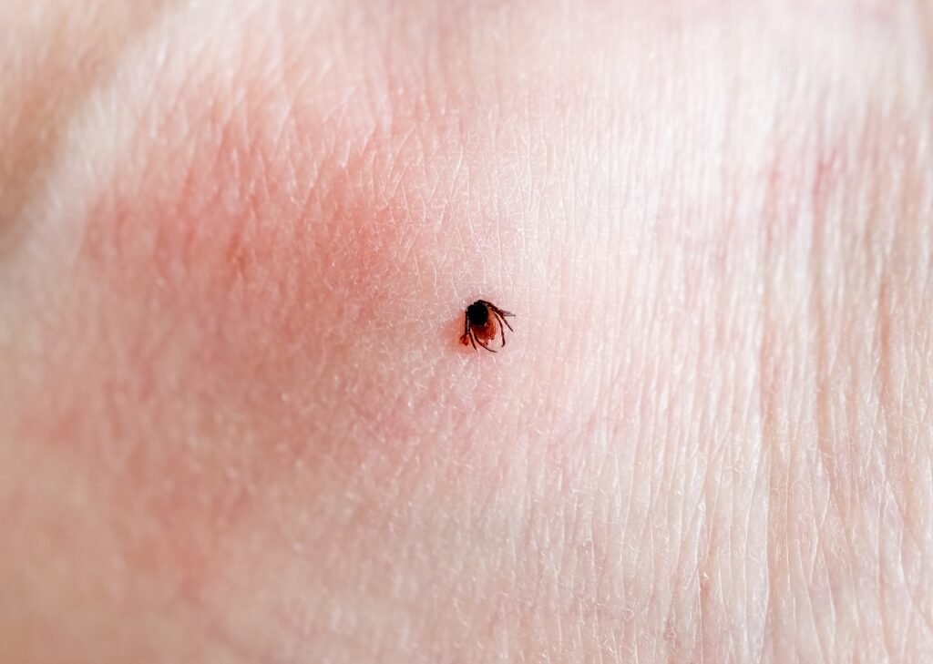 So schützen Sie sich vor Zeckenbissen beim Wandern und Campen 2 A tick embedded in a person skin.